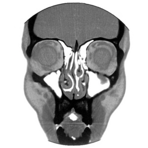 CT back projection with hundreds of angles